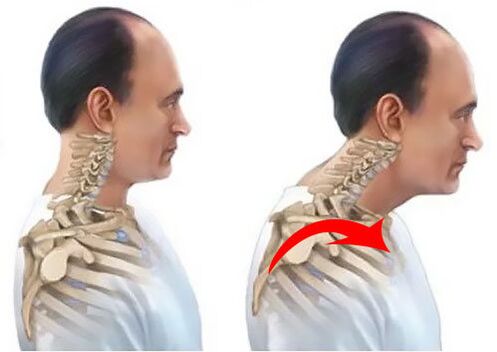 A healthy and sick spine