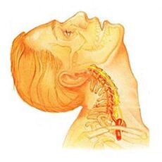 Osteochondrosis of the cervical spine