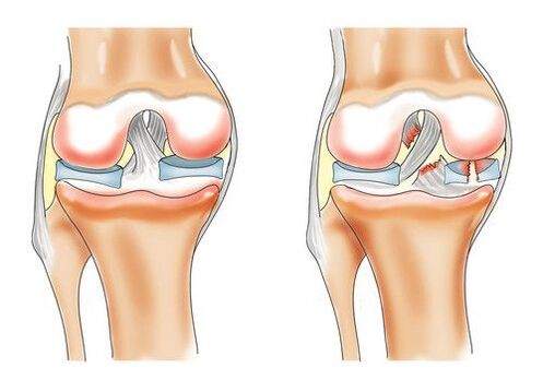healthy knee and osteoarthritis of the knee joint