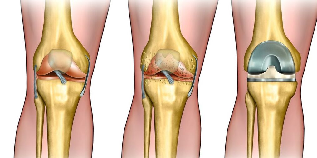 Knee wrist arthrosis